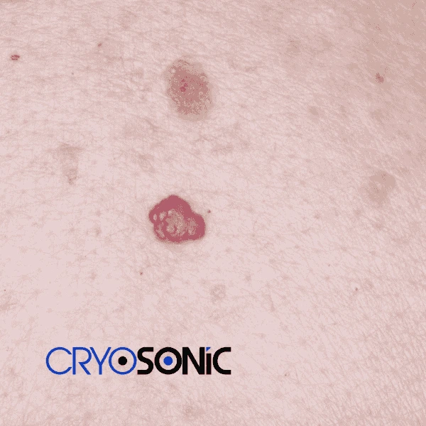 Looking for pain free cherry angioma removal treatment Birkenhead? Call our team today! Birkenhead