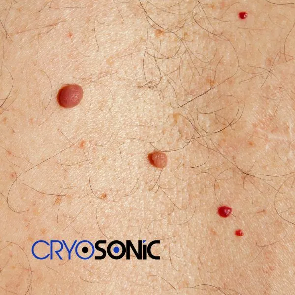 get cherry angioma removal treatment today! Birkenhead