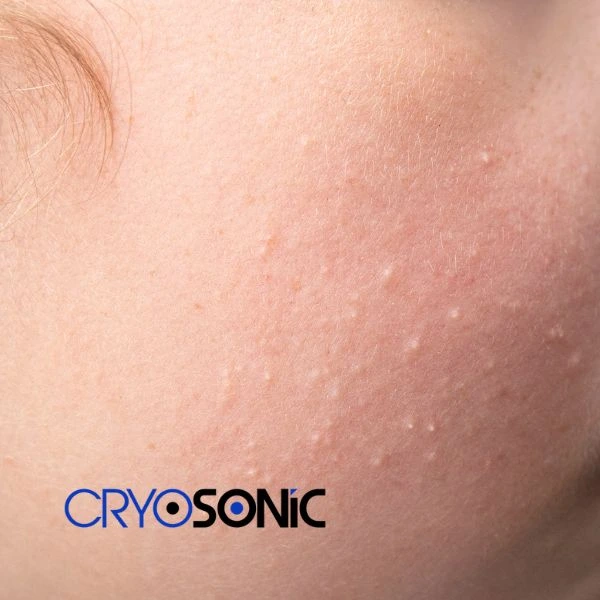 Are you looking for milia removal treatment? Contact our team today Birkenhead