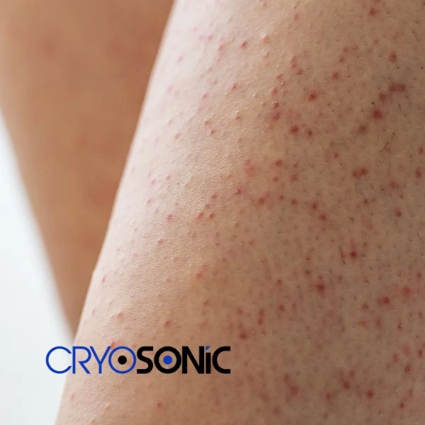 Looking for Seborrhoeic Keratosis removal Birkenhead treatment? Call our consultants today in Birkenhead