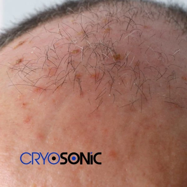 Access Seborrhoeic Keratosis removal from the comfort of your own home! Call us today in Birkenhead