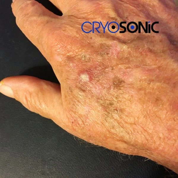 Understand more about actinic keratosis treatment today Birkenhead