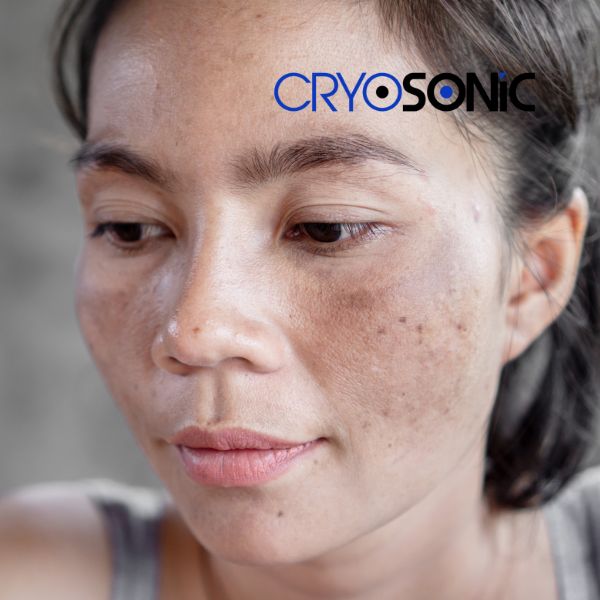 Ready to start age spots removal? Contact our team today in Birkenhead