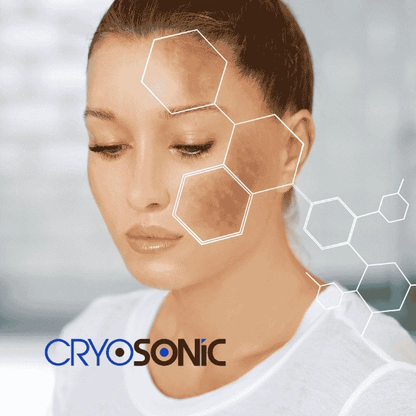 Are you looking for age spot removal treatment? Contact Cryosonic today in Birkenhead