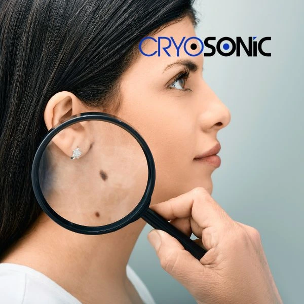 Do you want to learn more about benign moles removal treatment? Call our team today Birkenhead
