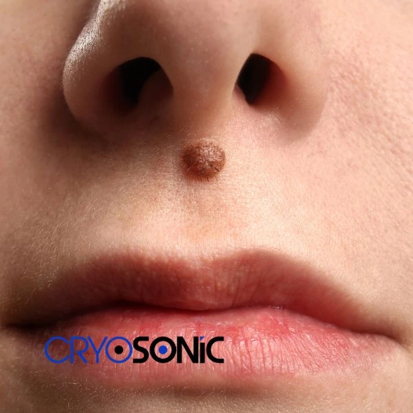 Start your benign moles removal treatment today Birkenhead