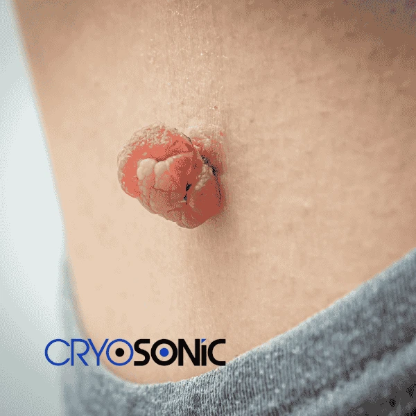 Book your skin tags removal Birkenhead from comfort of your own home! Birkenhead