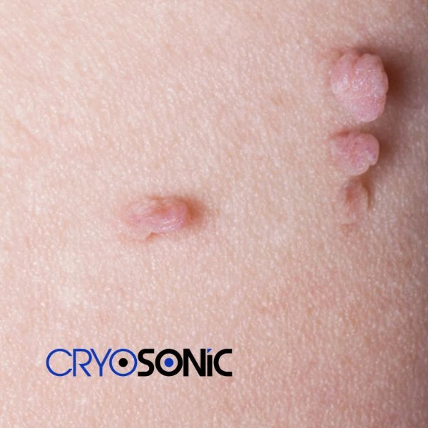 Are you looking for fast effect skin tag removal Birkenhead? Book in NOW! Birkenhead
