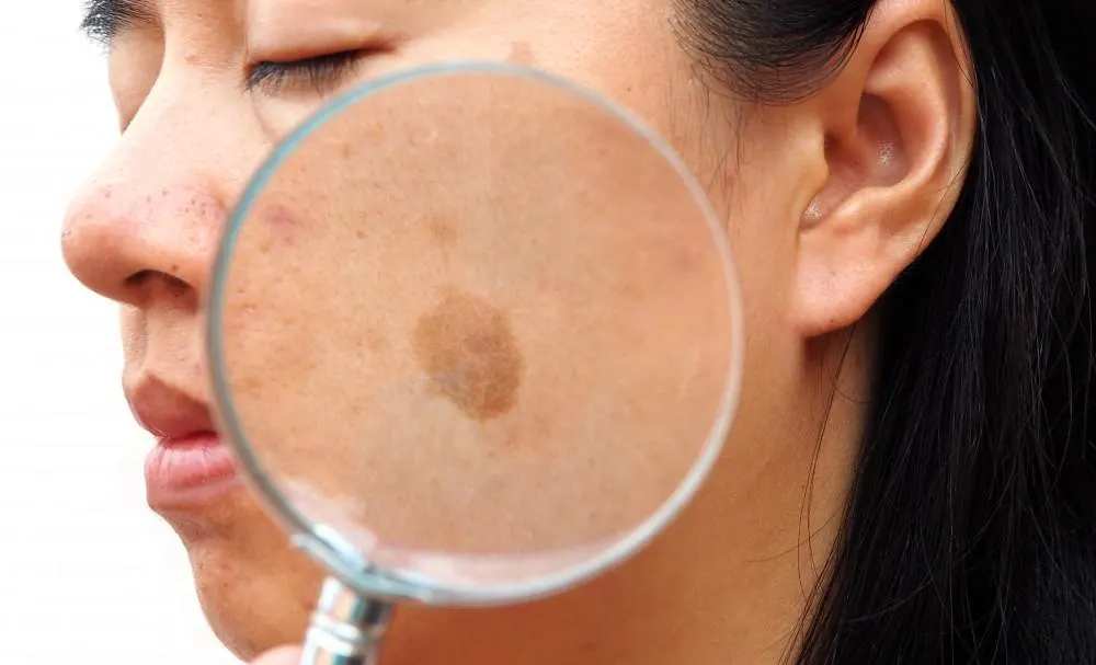 How Seborrheic Keratosis Birkenhead appears on the skin Birkenhead