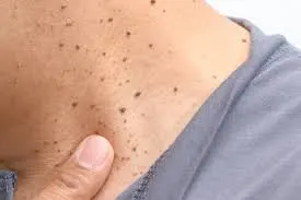 Seborrheic Keratosis: Understanding Skin Changes and CryoPen Treatment Options Birkenhead