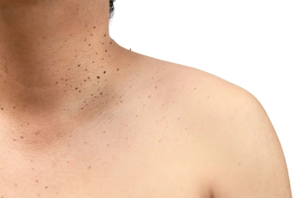 How to Maintain Healthy Skin After Treatment Birkenhead? Birkenhead