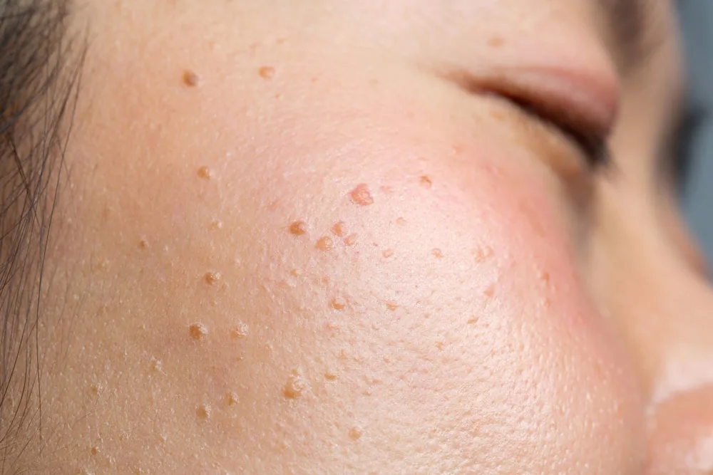 Why Choose CryoPen for Seborrheic Keratosis Birkenhead Birkenhead