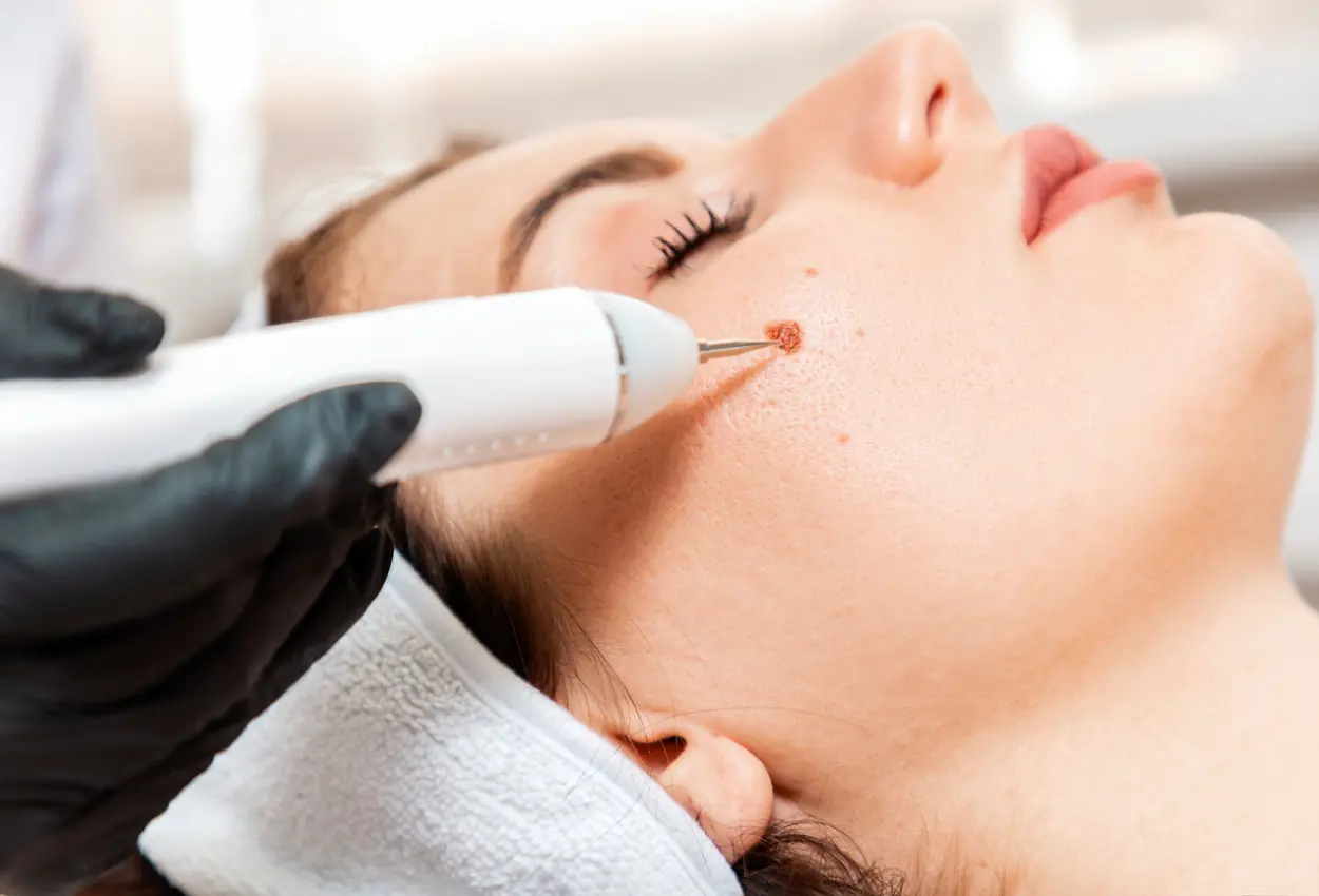 Frequently Asked Questions About Multiple Cryotherapy Treatments Birkenhead