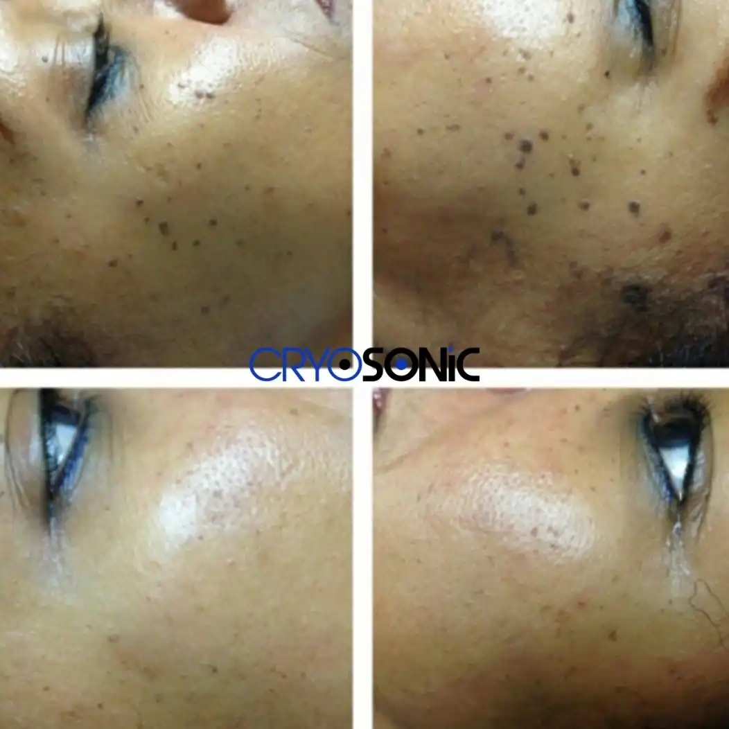 Why Skin Shows Pigmentation After Treatment Birkenhead