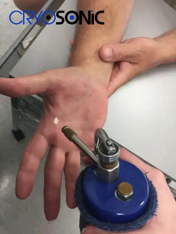 Temperature Differences: OTC vs Medical-Grade Cryotherapy Birkenhead